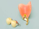 マルチコンアタッチメントの入れ歯・精密義歯