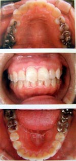 子供の顎を拡げる矯正装置・拡大矯正後