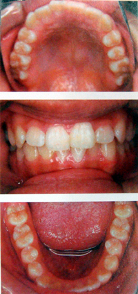 子供の顎を拡げる矯正装置・拡大矯正後