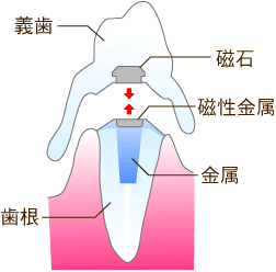 磁石の力で入れ歯を固定する