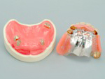 コーヌスアタッチメントの義歯